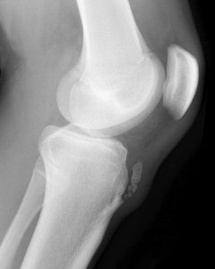 Radiogrpahie Genou - Osgood Schlatter